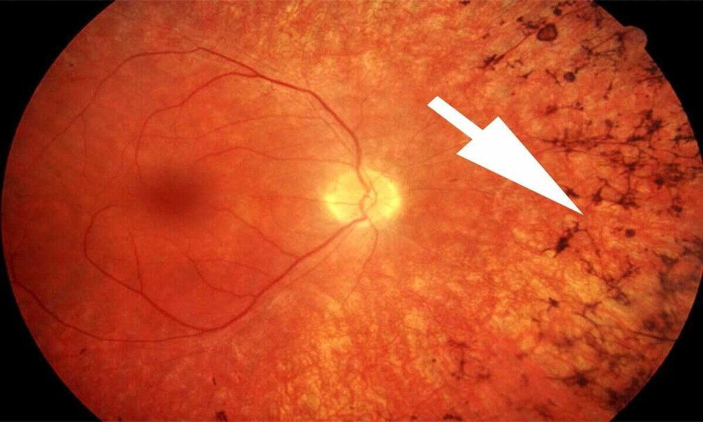 Night Blindness (Retinitis Pigmentosa) Treatment